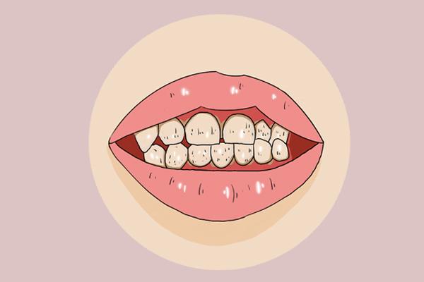 牙齿有黑点和一个洞是蛀牙吗（牙齿上有黑点是蛀牙吗）(3)