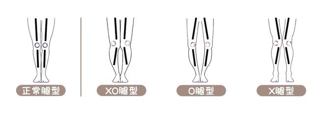 腿是x型腿应该穿怎样的裤子（o型腿和x型腿怎么选裤子）(2)